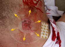 Load image into Gallery viewer, H*VENT Vented Chest Seals