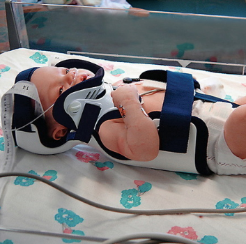 Papoose® Infant Immobilizer with PO Front, Infant Up to 3 Months