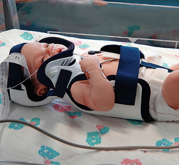 Papoose® Infant Immobilizer with PO Front and Pads, Infant Up to 3 Months